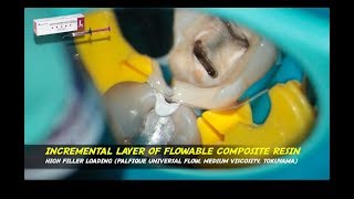 rewalling pre endodontic build up palfique universal flow tokuyama bioclear matrix mandibular molar [upl. by Radnaxela108]