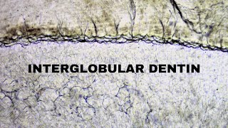 Interglobular dentin  Hypomineralized dentin  Dentistry Oral Histology 🔬 [upl. by Keraj]