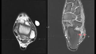 Lateral Ankle Sprains  Expert Explains Mechanism Of Injury and Rehab Plan [upl. by Thora113]