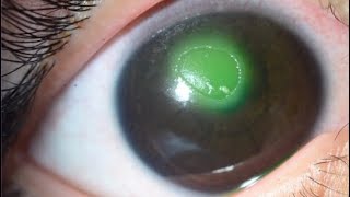 NEUROTROPHIC CORNEAL ULCER [upl. by Anir]