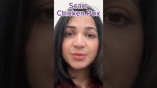 Chicken Pox Scars Treatment l Chicken Pox Face Care l Chicken Pox Skincare [upl. by Chapland]