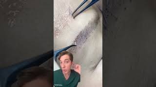 Eyebrow Hair Transplant How to Transform Your Brows [upl. by Yodlem610]