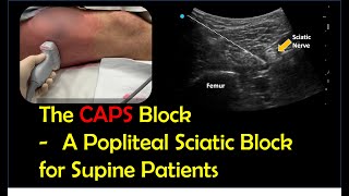 Lateral Popliteal Sciatic Block for Supine Patients CAPS block [upl. by Ivah117]