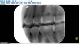 Incorrect horizontal angulation in bitewing radiographs [upl. by Molton]