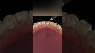 Dental Scaling Procedure medicalanimation health shorts [upl. by Lull441]