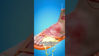 Should You Pop a Huge Blister The Truth About Drainage [upl. by Ecnarf]