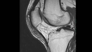 Prepatellar bursitis [upl. by Kcinnay]