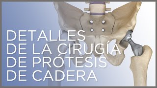 Detalles de la cirugía de prótesis de cadera Dr Ángel Villamor [upl. by Kaleena]