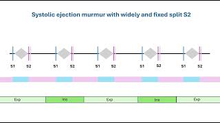 Systolic ejection murmur with fixed split S2 [upl. by Narat769]