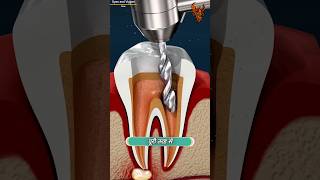 How Root Canal Works 😯  रूट कैनाल कैसे काम करता है  shorts [upl. by Hallett]