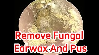 Remove Fungal Earwax And Pus  EP 025 [upl. by Tiphanie903]