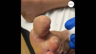 Tip of Big Toe Callus [upl. by Lemar]