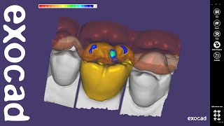 exocad Video Tutorial Basic Features  Anatomic Coping with Cutback [upl. by Notyalk]