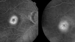 FFA CLASSIFICATION OF CNVM Choroidal neovascular membrane  Occult vs Classic CNVM [upl. by Namyh]