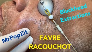 Favre Racouchot syndromeDozens of comedones extractedWhiteheads and blackheads Clearing the pores [upl. by Tye235]