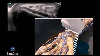 How To Ultrasound Guided Radial Artery Catheterization Trans 3D Video [upl. by Eliathan325]