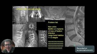 Spine Conference infected nonunion of the lumbar spine [upl. by Grane]