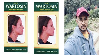 dont use wartosin wart remover  honest review [upl. by Hairej]