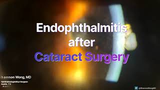 Endophthalmitis after cataract surgery [upl. by Henrik691]