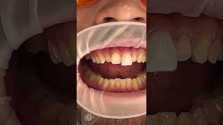 Veneers Process [upl. by Lama468]