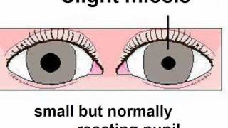 Syndromes of the ANS  Part 4  Horners Syndrome [upl. by Airtemed]