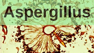 Aspergillus and Aspergillosis  Pathology mini tutorial [upl. by Nahsed545]