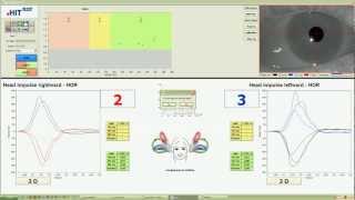 eHIT Video Head Impulse Test Demonstration [upl. by Jamel]