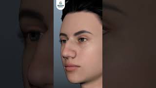 Recovery Period After Rhinoplasty Surgery rhinoplastyrecovery [upl. by Miner]