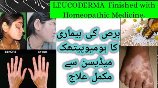 quotLeukoderma Leucoderma Treatment with homeopathic RemedyquotDoctor Abida [upl. by Holms125]