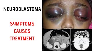 NEUROBLASTOMA Symptoms Signs Causes Treatment [upl. by Clorinda]