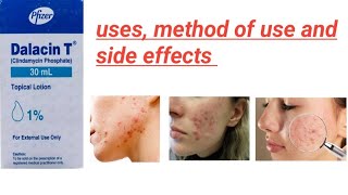 Dalacin T lotion uses and method of use in Urdu best for acne used on dr prescription only [upl. by Ul]