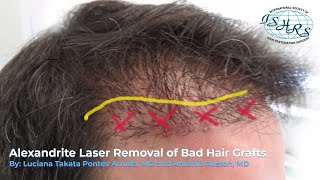 Alexandrite Laser Removal of Bad Hair Grafts [upl. by Booker]