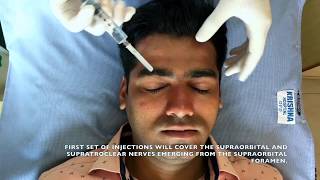 Regional Nerve Block for Scalp  Local Anaesthesia for PRP amp other scalp procedures [upl. by Nedyaj]