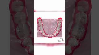 ORTHODONTIC SPACE CLOSURE  ORTHODONTIC TIPS Shorts [upl. by Kilam]