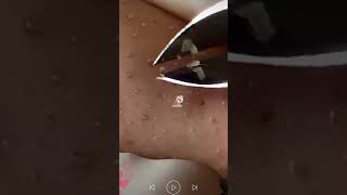 Skincare  Blackheads Removal 307 tweezers skincare blackheads blackheads [upl. by Elad]