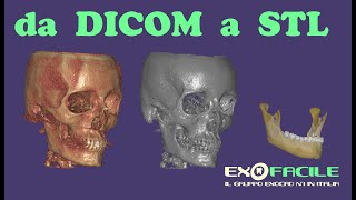 da DICOM a STL parte 1 [upl. by Potter]