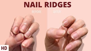 Nail Ridges The Silent Signaling Your Nails Are Trying to Tell You [upl. by Claudetta]