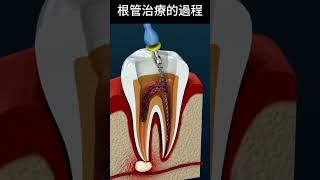 根管治療的過程 dentist 牙齒 [upl. by Lirba46]