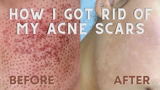 HOW I GOT I GOT RID OF MY ACNE SCARS  Fibroblast Skin Tightening Before and After [upl. by Grady]