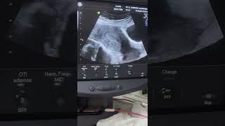 Two different cases of Endometrial Hyperplasia diagnostic ultrasound cases [upl. by Yeta]