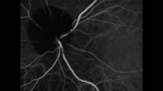 Ophthalmic Melanocytoma of the Optic Nerve [upl. by Zolner]