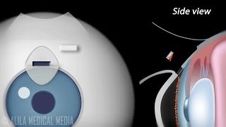 Trabeculectomy Surgery for Glaucoma Animation [upl. by Sedda]