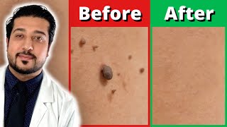 How to Rid Skin Tags FASTER  3 Easy Skin Tag Removal Steps [upl. by Htederem]