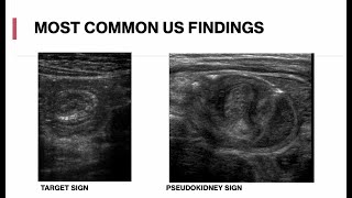 Pediatric Abdominal Ultrasound  Appendicitis Intussusception Mesenteric Adenitis [upl. by Suiluj]