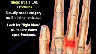 Metacarpal Fractures  Everything You Need To Know  Dr Nabil Ebraheim [upl. by Zenda]