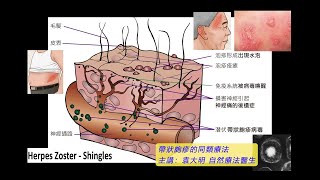 《自然療法與你》 EP675  帶狀皰疹的同類療法 [upl. by Wenda319]