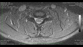 Cervical endoscopic foraminotomy [upl. by Laved978]