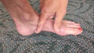 Sesamoid Evaluation and Treatments [upl. by Hanser213]