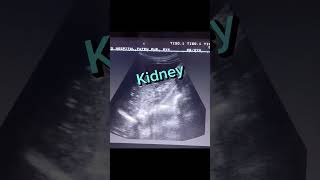 Echogenic Kidney shorts youtube viral [upl. by Card]