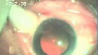 Intravitreal Injection Avastin In WET AMD Dr Sudhalkar [upl. by Colette734]